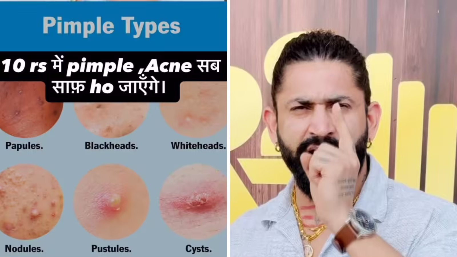 दाने, फोड़े-फुंसी भरा है चेहरा? बस 10 दिन में होंगे गायब, रात भर पानी में भिगोएं मोती जैसी ये चीज, फिर देखना कमाल