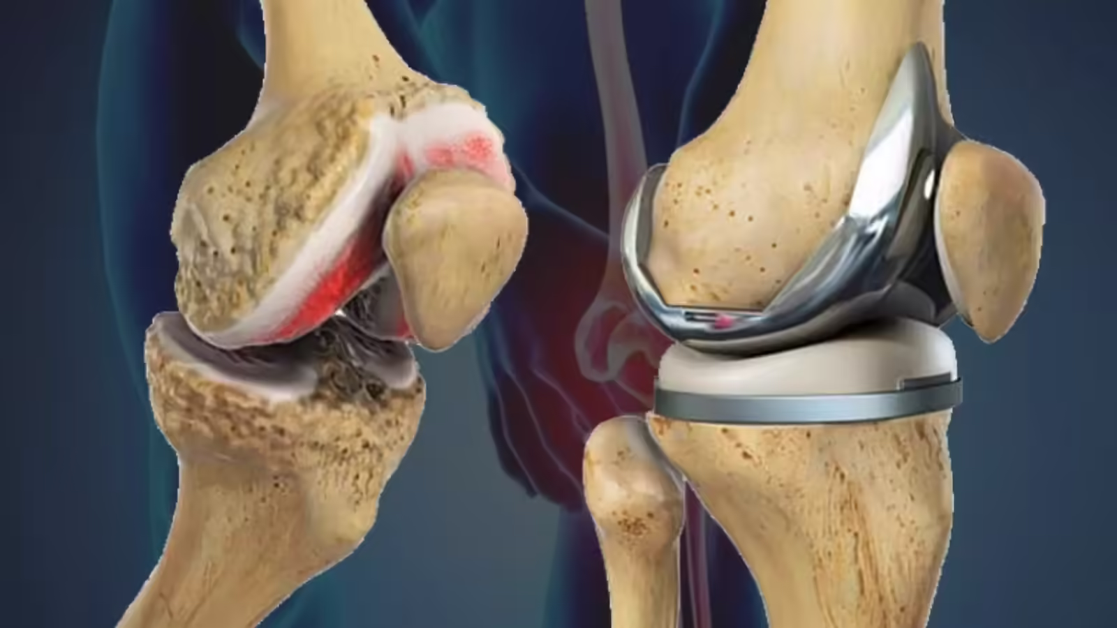 जांघ के टिशू से बना दिया घुटने का कुशन, देश की पहली ‘नी-सैल्वेज’ सर्जरी