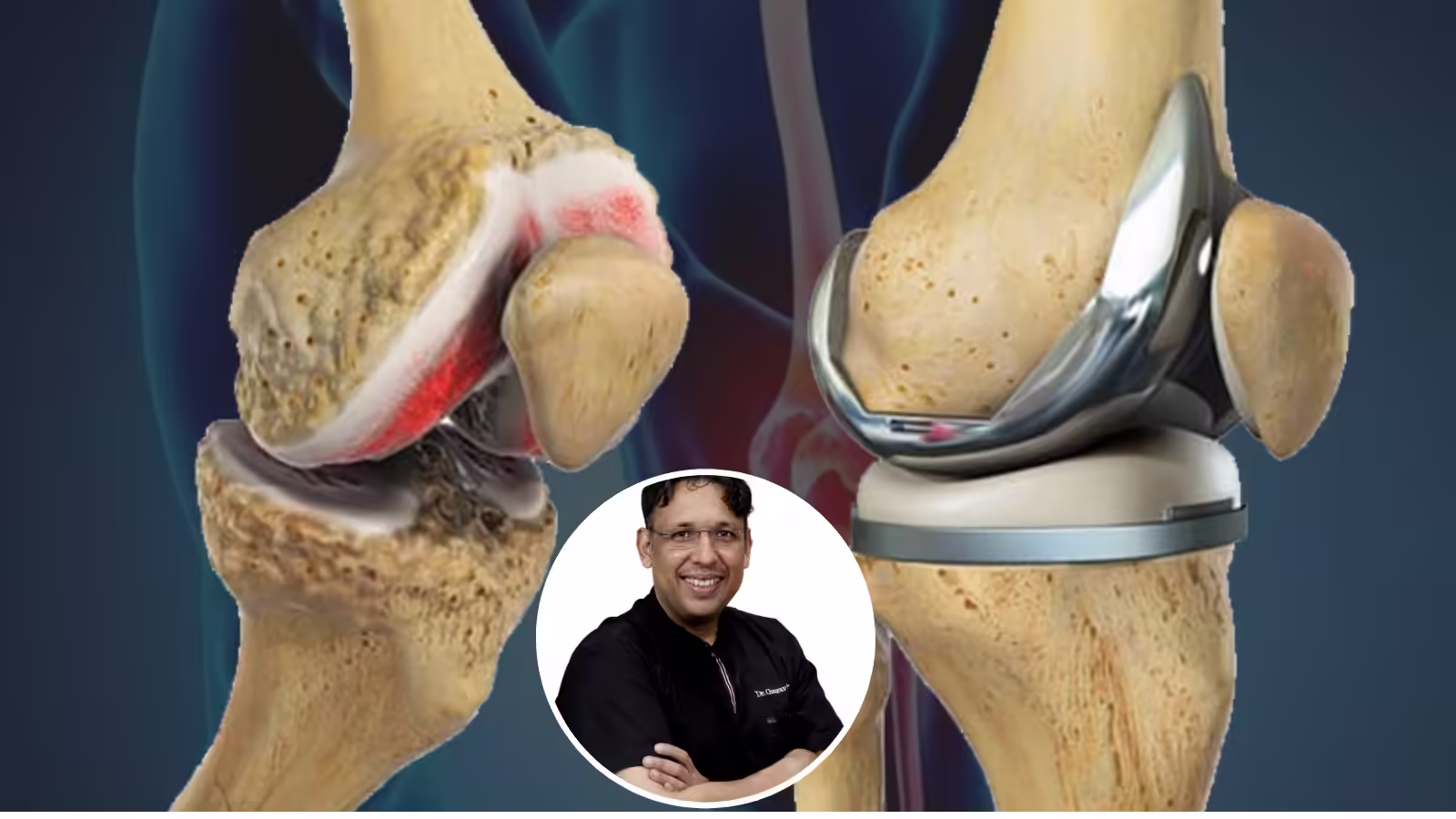 Knee replacement कराने जा रहे हैं? जॉइंट रिप्लेसमेंट सर्जन डॉ. गौरव गुप्ता ने बताया सही इम्प्लांट क्यों है जरूरी