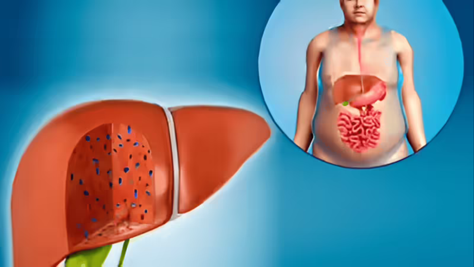 देश 10 में से 4 वयस्कों को फैटी लिवर, स्टडी में चौकाने वाला खुलासा